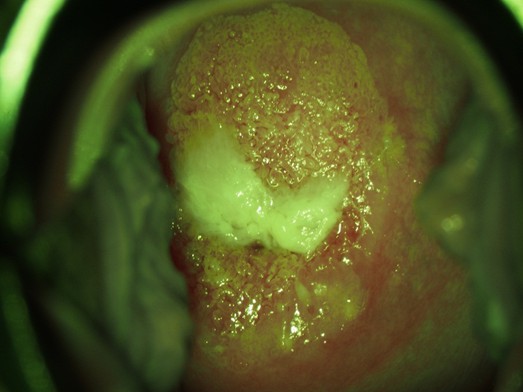 画像に alt 属性が指定されていません。ファイル名: 子宮頸部癌化-2.jpg